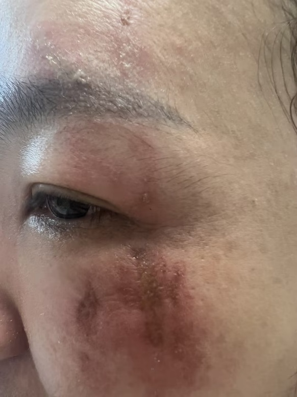 隐翅虫皮炎症状
